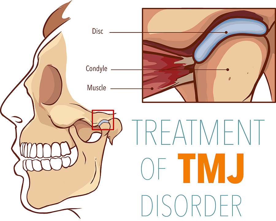 Effective TMJ Treatment in Colorado Springs, CO: Relieving Jaw Pain for a Healthier Life